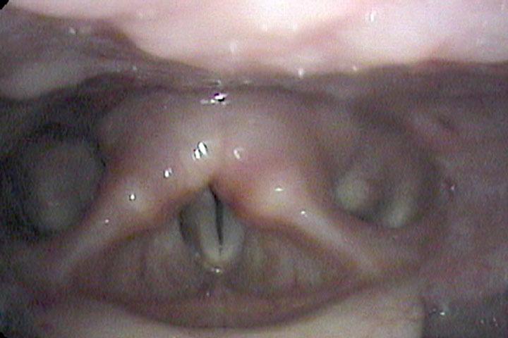 endoscopic overview of case study vocal cords in their maximum open position