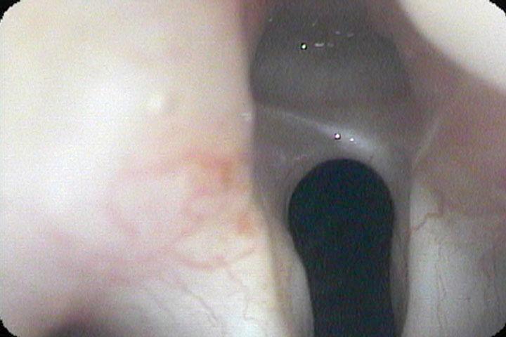 Scar band in the posterior subglottis beneath the vocal processes