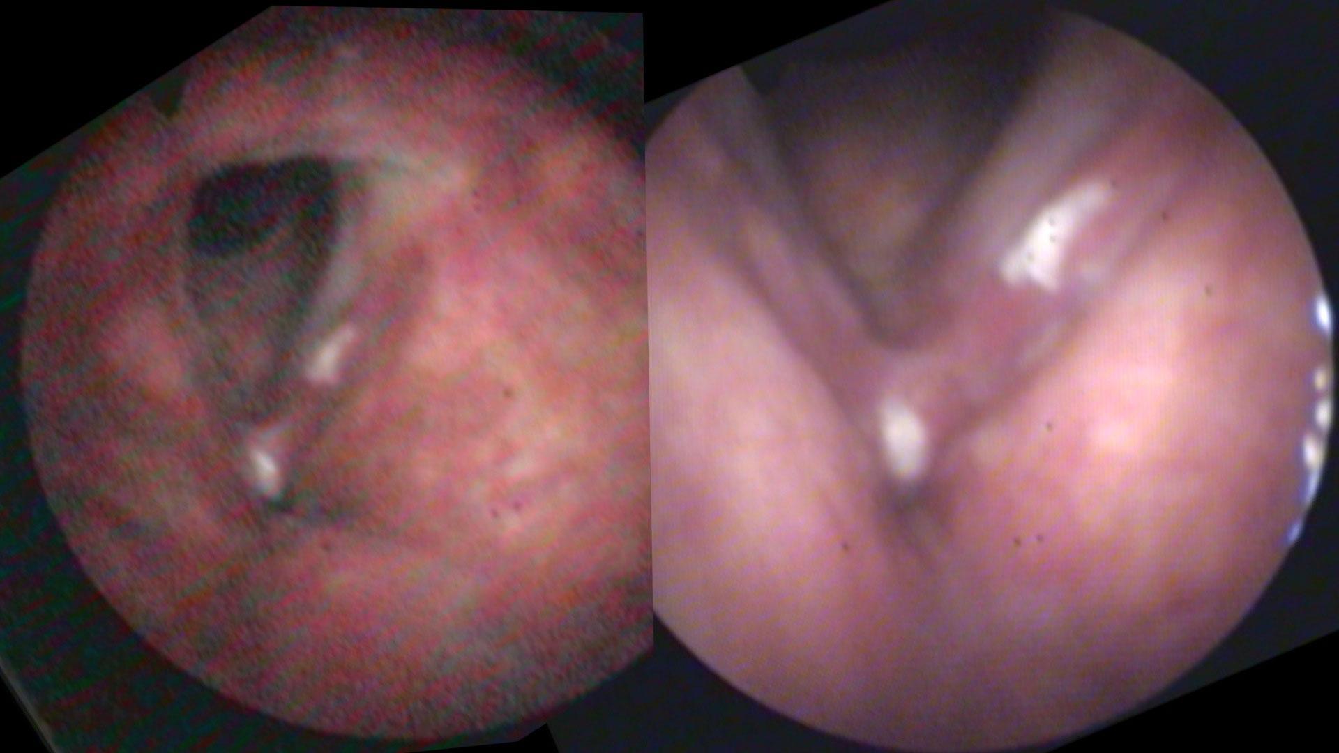 Same person, same day, same camera. The image on the right is taken with the endoscope closer to the larynx so that more light is on the larynx and the auto gain feature is reduced.