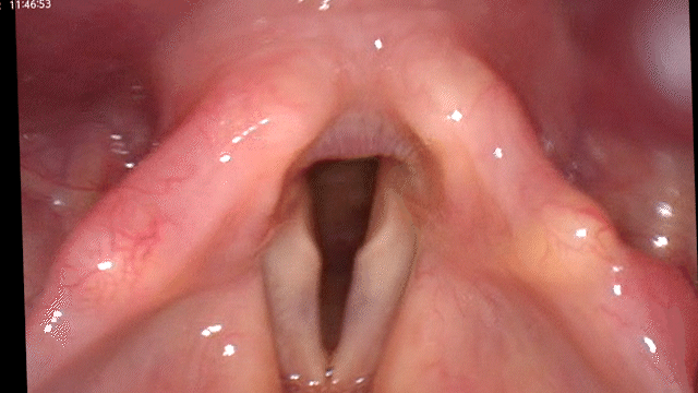Vocal cords during breathing