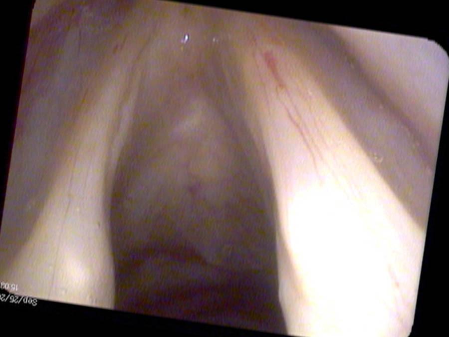 Left vocal cord paralysis, ultra close up view of the left sided atrophy