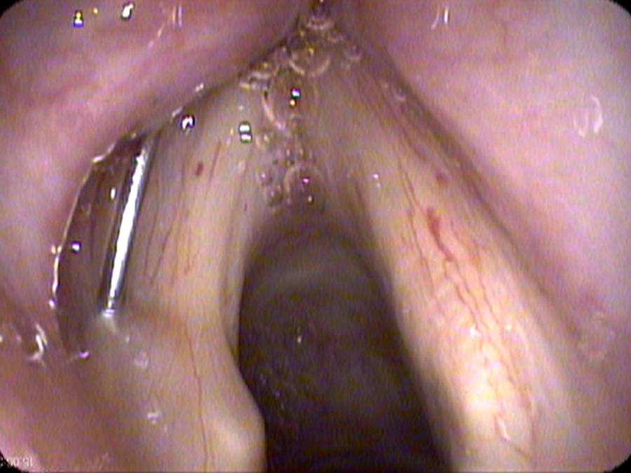 Needle entering the left vocal cord from above the thyroid cartilage for the injection of collagen into the left vocal cord
