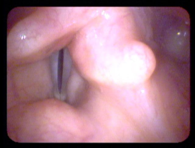 At high pitch, the vocal cords are newly symmetric because the cricothyroid muscle pulls the weak cord tight