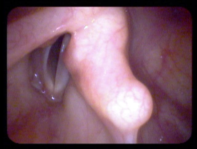 at low pitch, the weak right vocal cord flutters because there is no compensation from the cricothyroid muscle