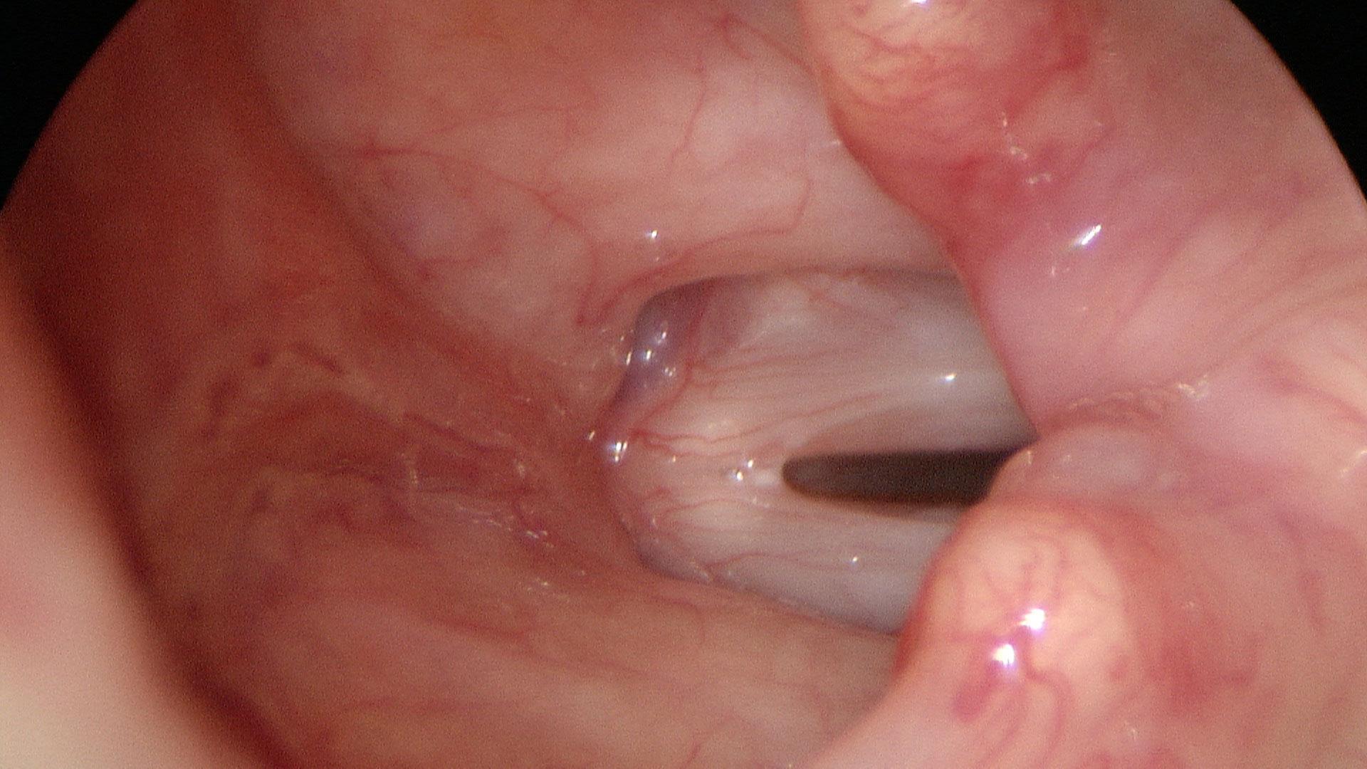 Vocal cord margins when viewed at low pitch, lesions are hidden