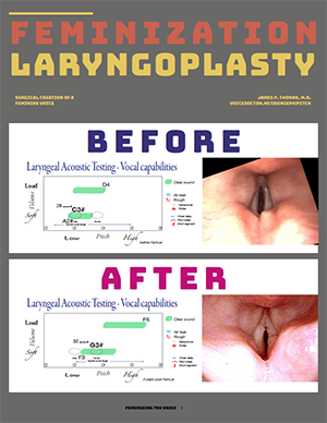 Feminization Laryngoplasty technique