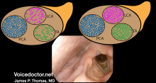 Lateral cricoarytenoid paresis visualization