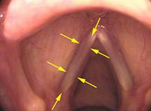 ThyroArytenoid (TA) Muscle